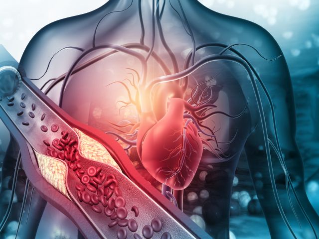 Darstellung des menschlichen Herzens mit verengter Arterie und eingeschränktem Blutfluss.