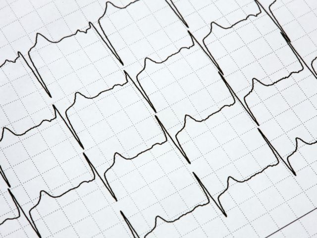 EKG-Kurve auf einem medizinischen Diagramm zur Herzdiagnostik.
